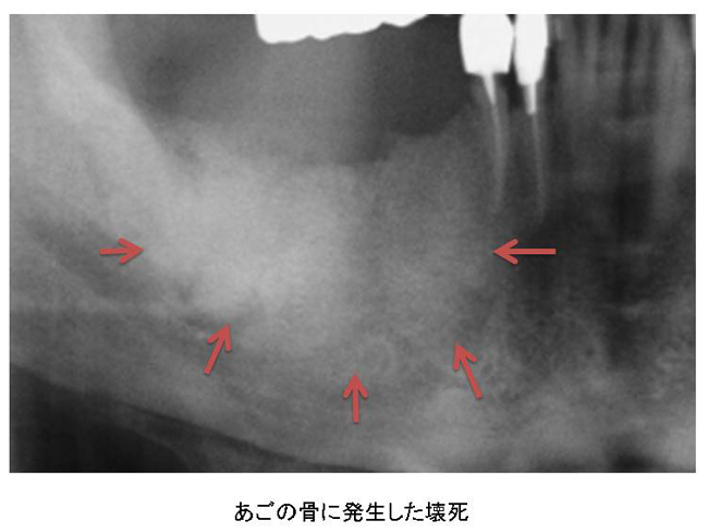 あごの骨に発生した壊死