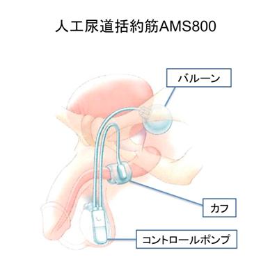 図：人工尿道括約筋AMS800