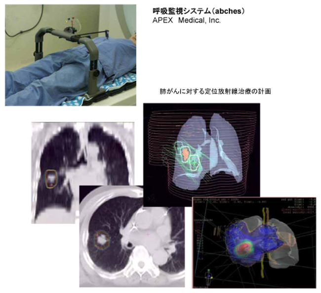 呼吸監視システム・肺がんに対する定位放射線治療の計画