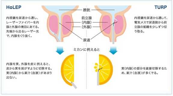 図２．ホルミウム・ヤグレーザー前立腺核出術(HoLEP)と経尿道的前立腺切除術(TUR-P)の比較説明
