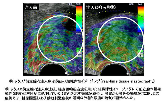 ボトックス前立腺内注入療法前後の組織弾性イメージング