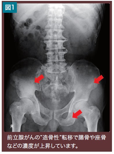 し 骨 癌 転移 やすい
