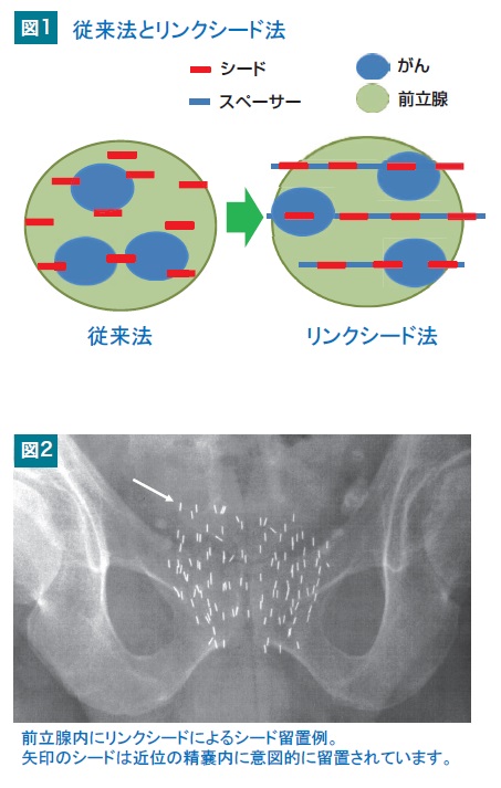 HP_前立腺がんに対する密封小線源治療.jpg