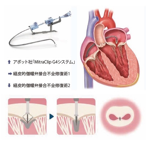 値頃 心臓弁膜症に対するMitraClip（マイトラクリップ：経皮的僧帽弁 健康・医学