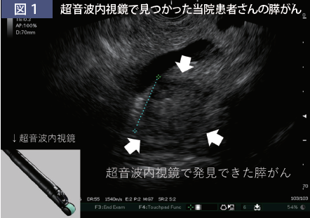 図1超音波内視鏡