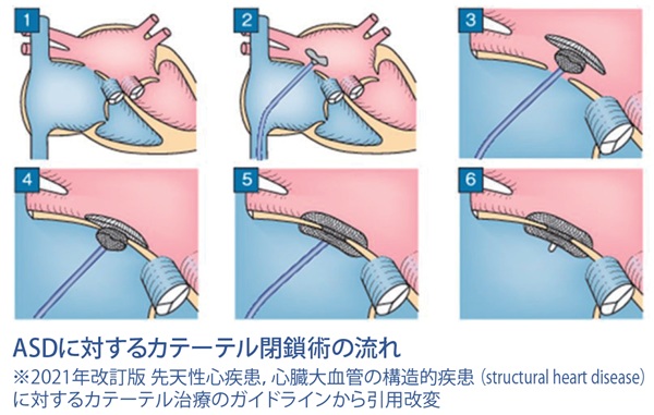 ASDに対するカテーテル閉鎖術の流れ