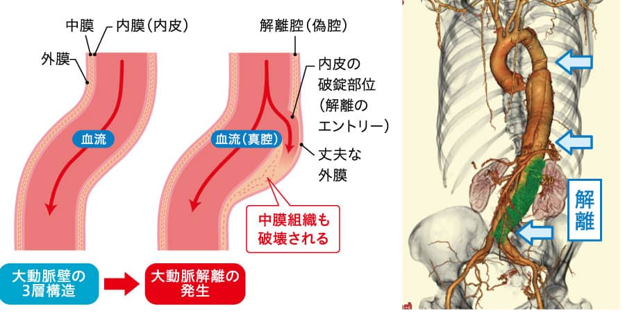 解離性大動脈瘤のなりたちの図と実際の解離した部分を示したCT画像