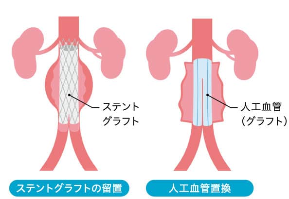 人工血管置換術とステント治療の図
